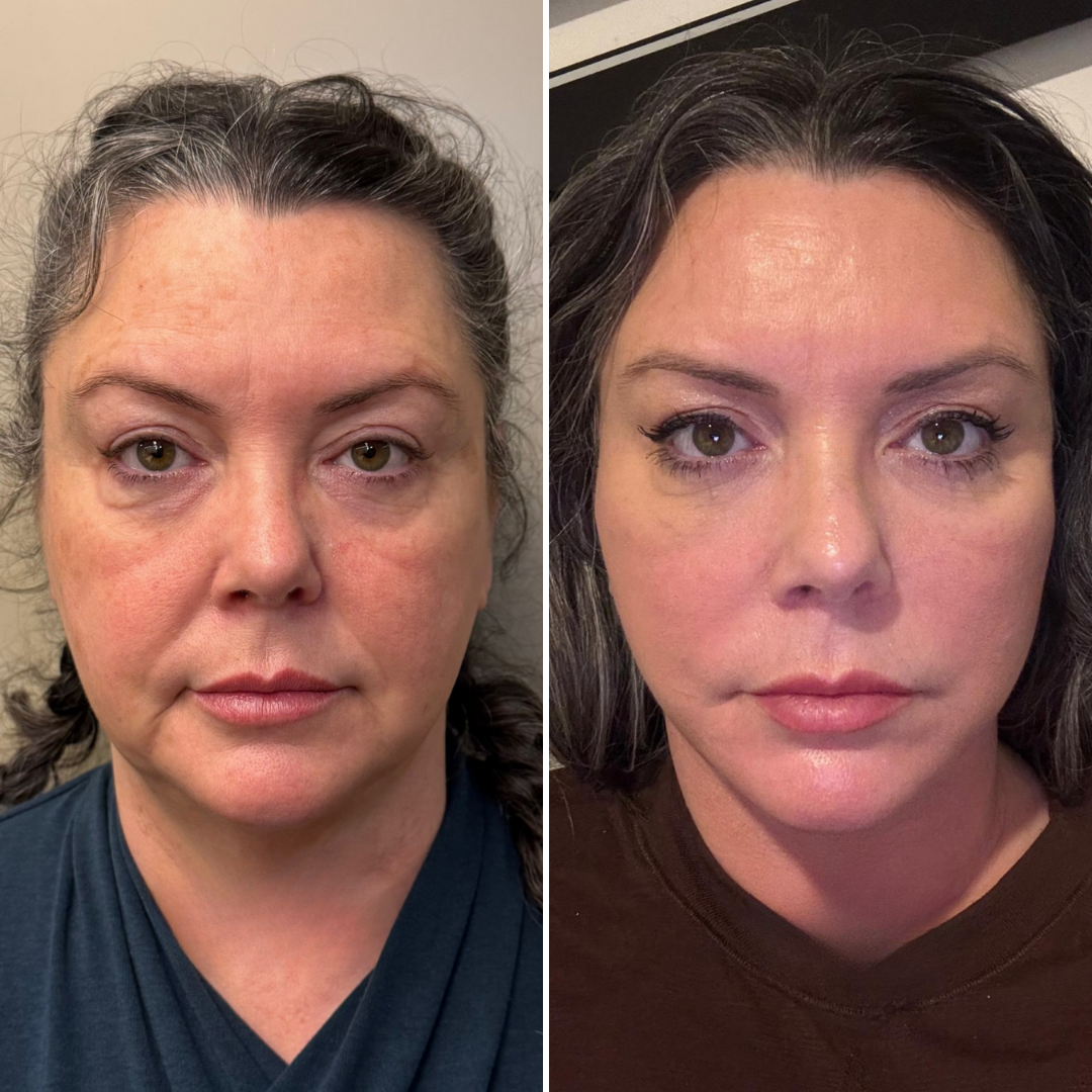 Emily V. before and after